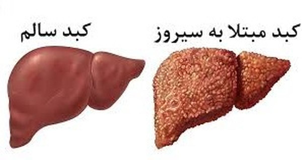 9 علامت بیمار شدن کبد