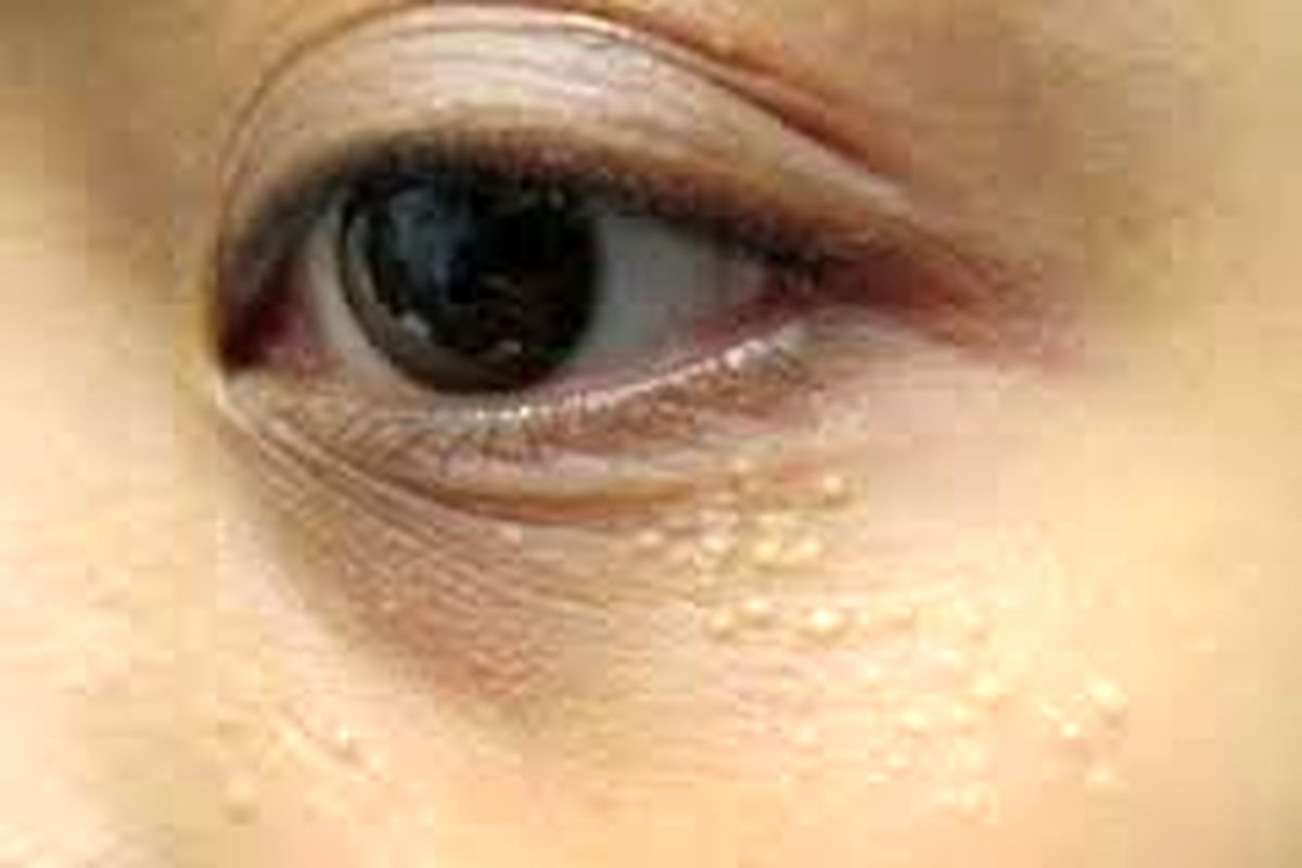 علت جوش های سفید رنگ زیر چشم چیست؟ 