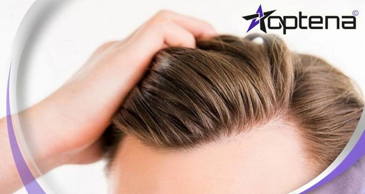 با جدیدترین روش های کاشت مو در دنیا آشنا شوید!【سال ۱۴۰۲】