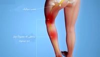 درد سیاتیک چیست؟+راه های درمان سیاتیک