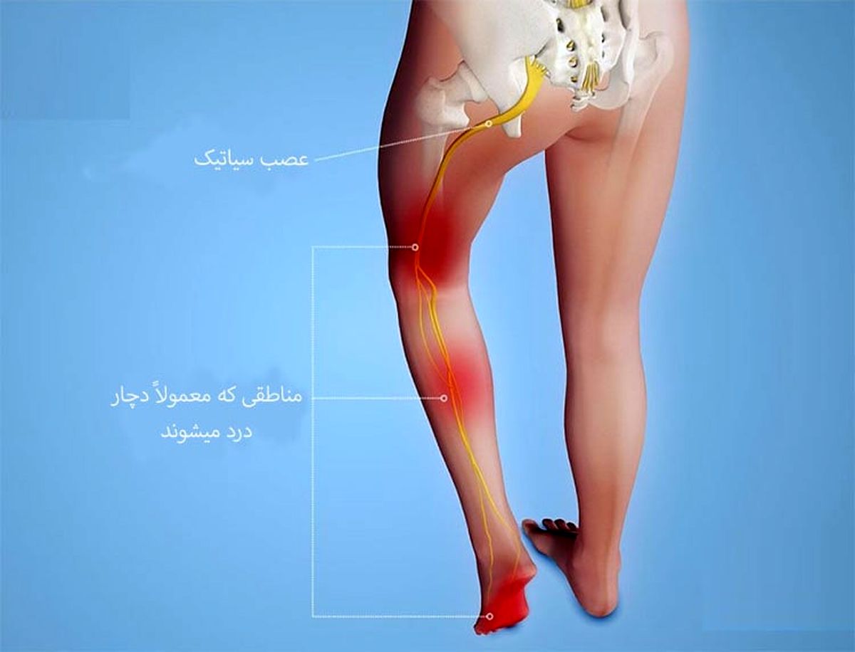 درد سیاتیک چیست؟+راه های درمان سیاتیک