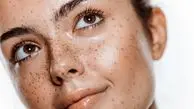 18 روش خانگی برای از بین بردن لکه های قهوه ای صورت و بدن