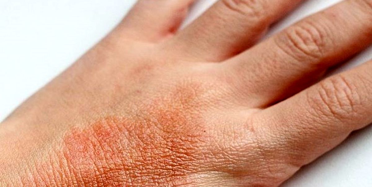 توصیه‌هایی برای پیشگیری از بروز «اگزما» در فصل پاییز