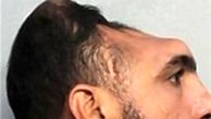 این مرد با سر نصفه زندگی می کند + تصاویر