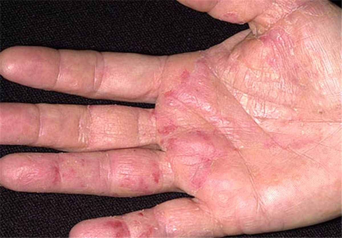  تدابیر تغذیه رفع کهیر از منظر طب سنتی 