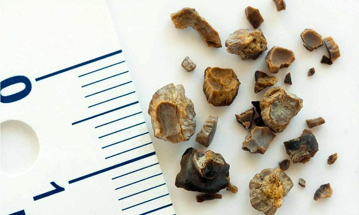 راهکارهای جالب برای درمان سنگ کلیه