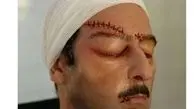 صورت بخیه خورده رامین ناصرنصیر + عکس