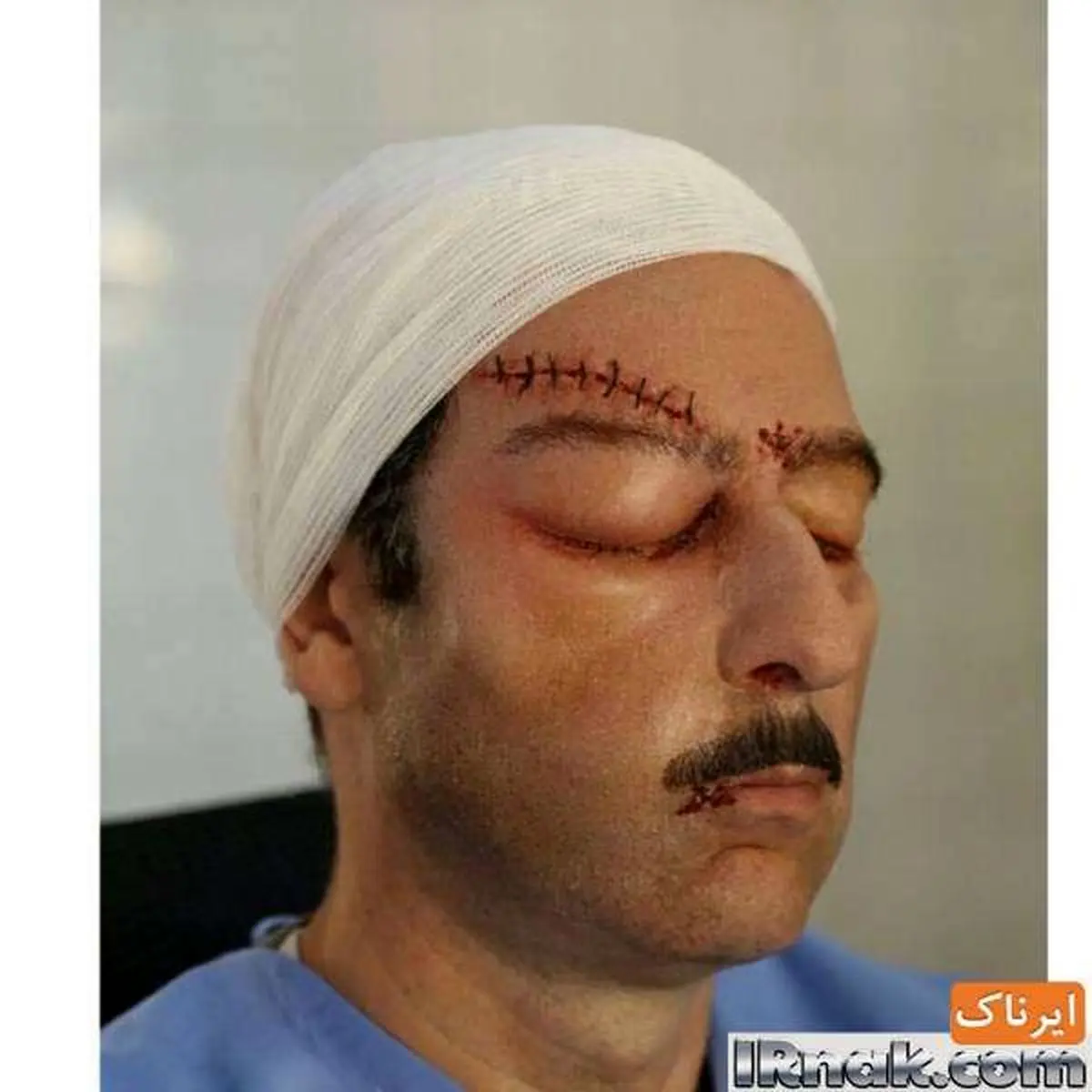 صورت بخیه خورده رامین ناصرنصیر + عکس