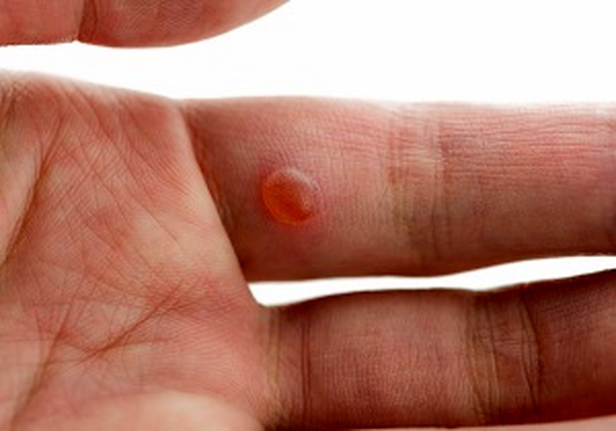 تبخال با صحبت کردن نیز منتقل می‌شود 