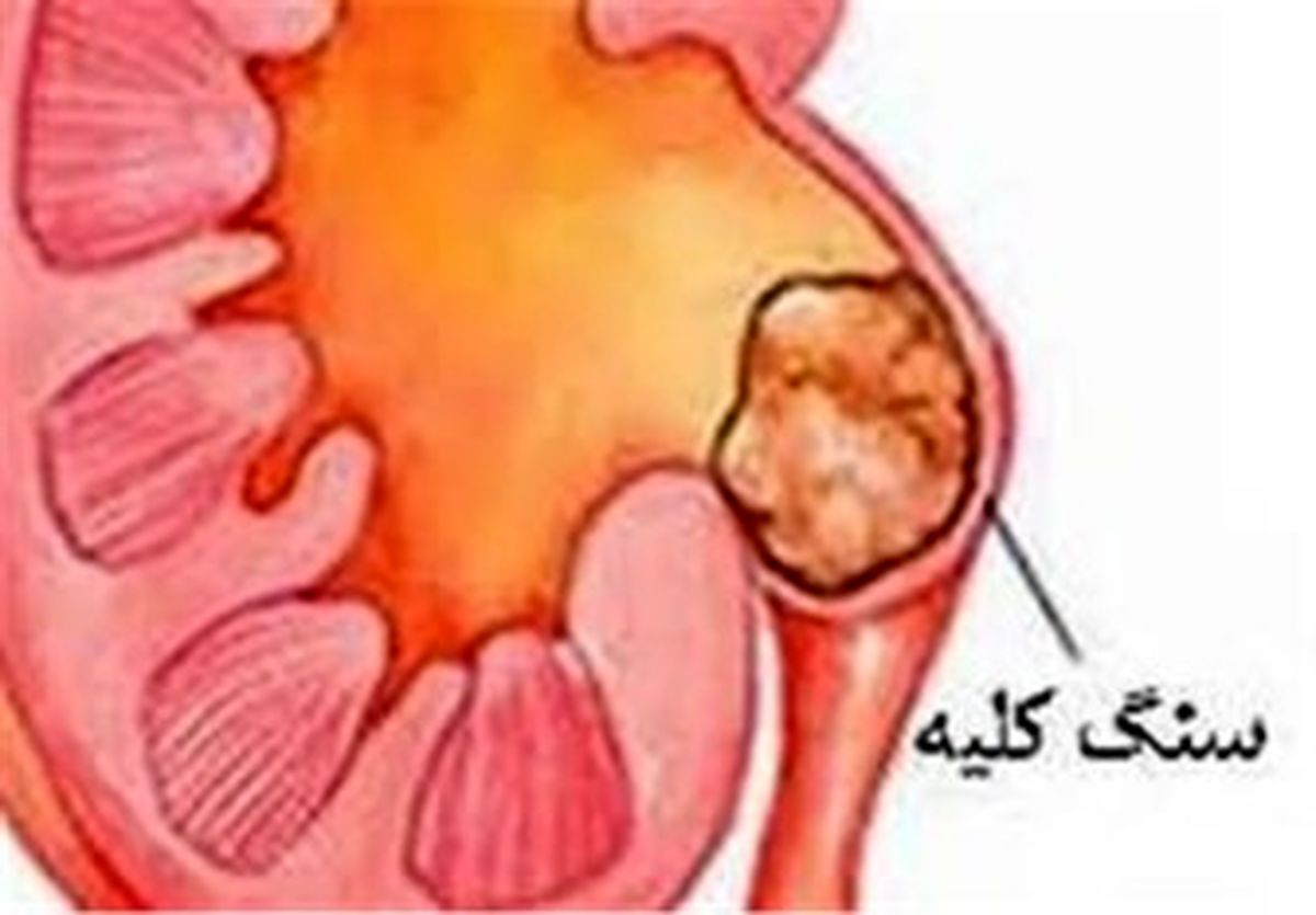 مصرف بیش از حد ویتامین C، سنگ کلیه می‌آورد