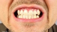 علت دندان قروچه در روز و شب چیست ؟ عوارض ؛ پیشگیری ؛ درمان