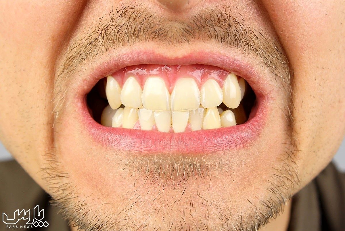 علت دندان قروچه در روز و شب چیست ؟ عوارض ؛ پیشگیری ؛ درمان