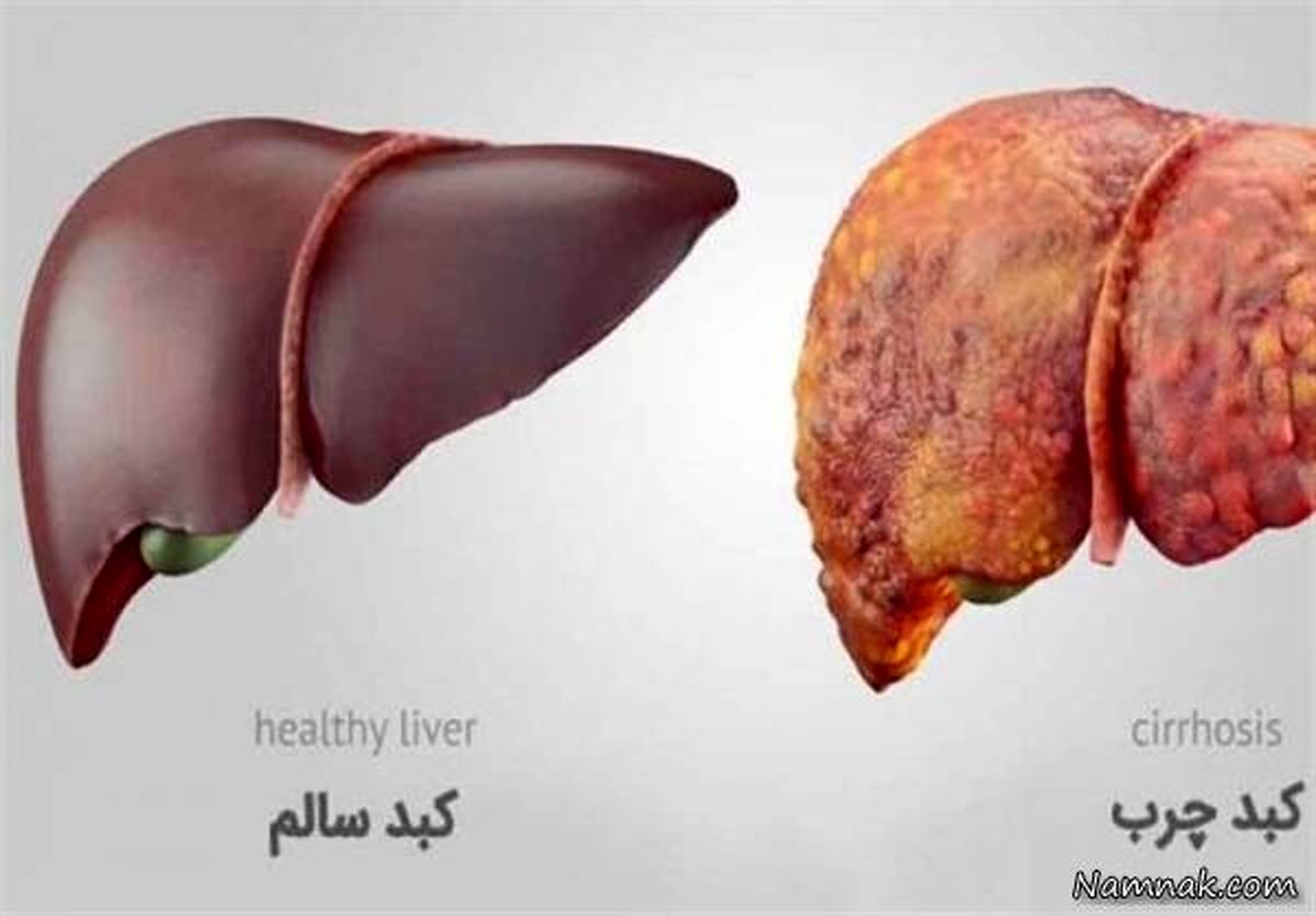 درمان کبد چرب با استفاده از طب سنتی