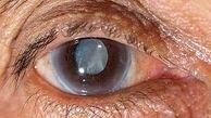 راه های پیشگیری از ابتلا به آب سیاه 