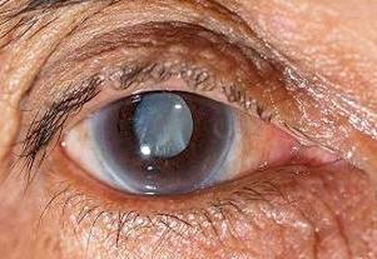 راه های پیشگیری از ابتلا به آب سیاه 