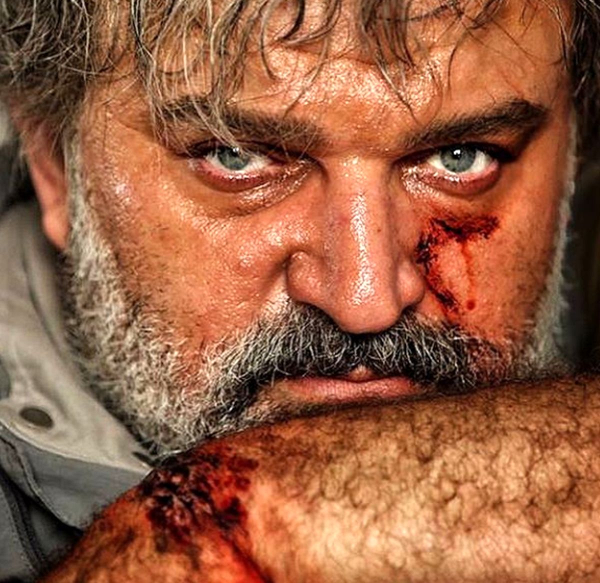 صورت کبود و آسیب دیده مهدی سلطانی+عکس
