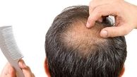 محققان : یک نوشیدنی پرمصرف باعث ریزش موی زودرس می‌شود