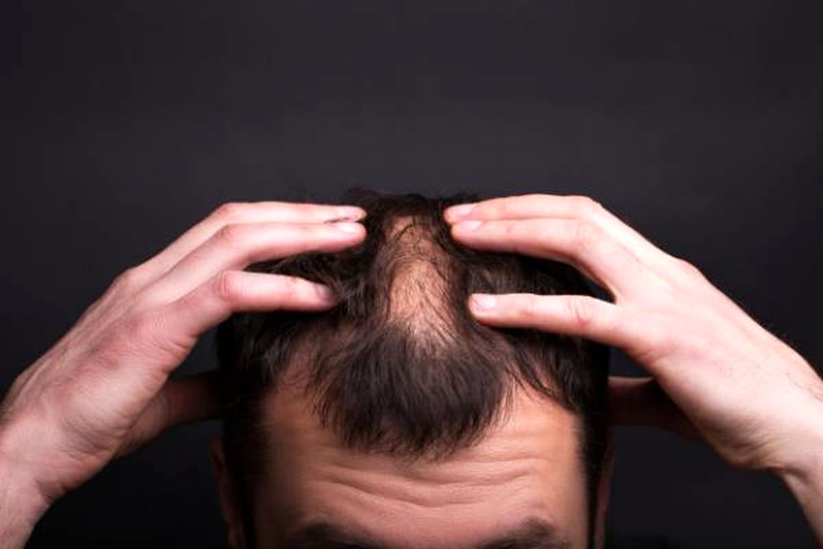 تاثیرات بی خوابی بر روی زیبایی و سلامت مو