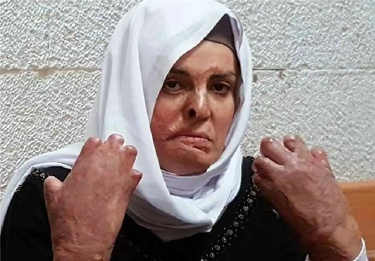 بی‌اعتنایی اسرائیل به زن اسیر فلسطینی با 50 درصد سوختگی