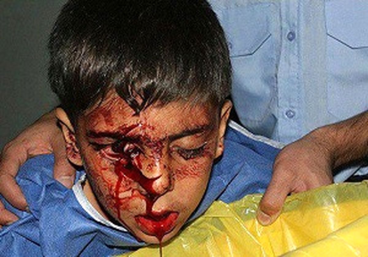 توصیه‌هایی برای حفظ سلامت چشم در چهارشنبه سوری 